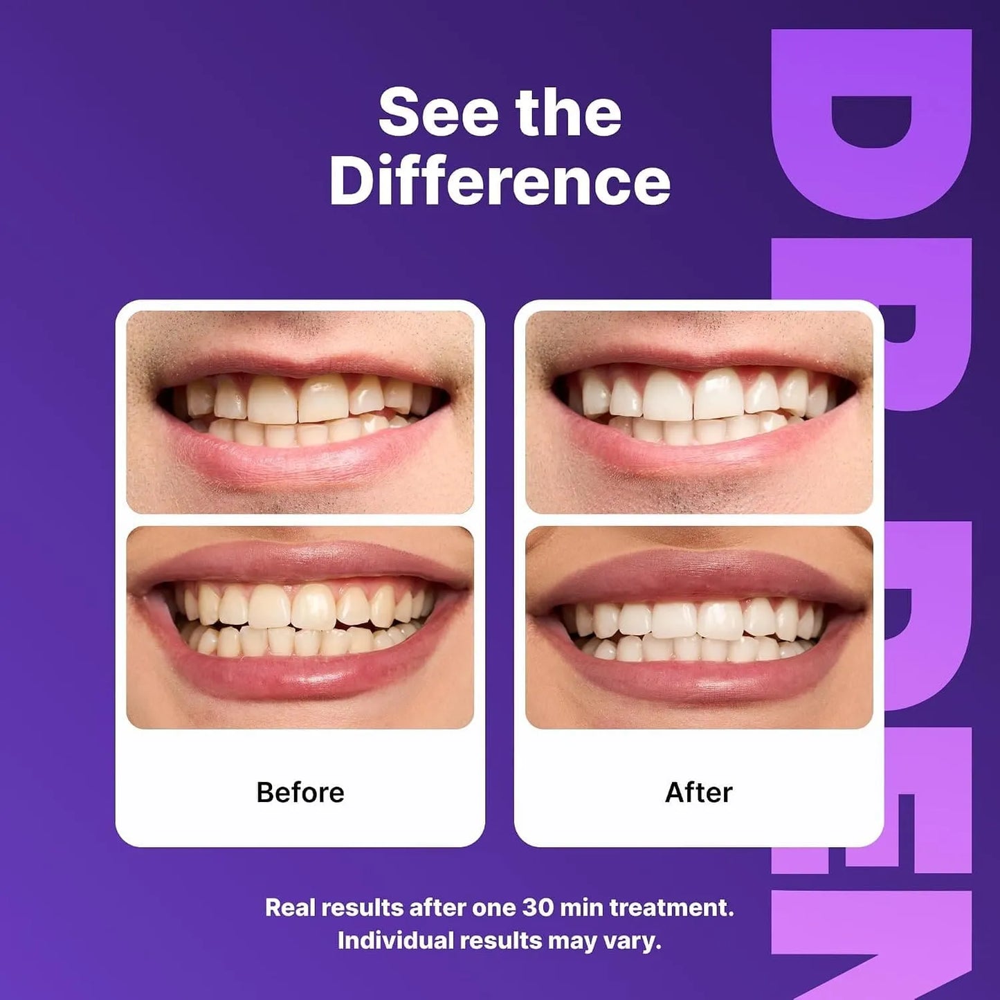 Purple Teeth Whitening Strips - Safe for Enamel