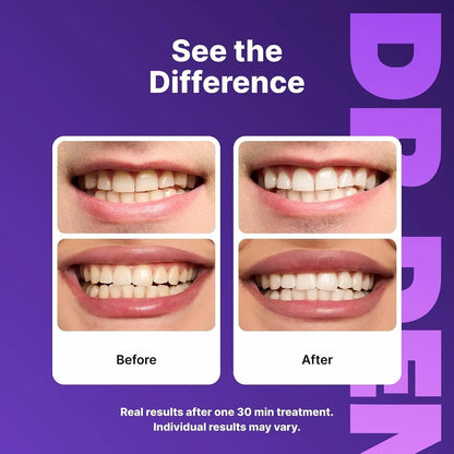 Purple Teeth Whitening Strips - Safe for Enamel